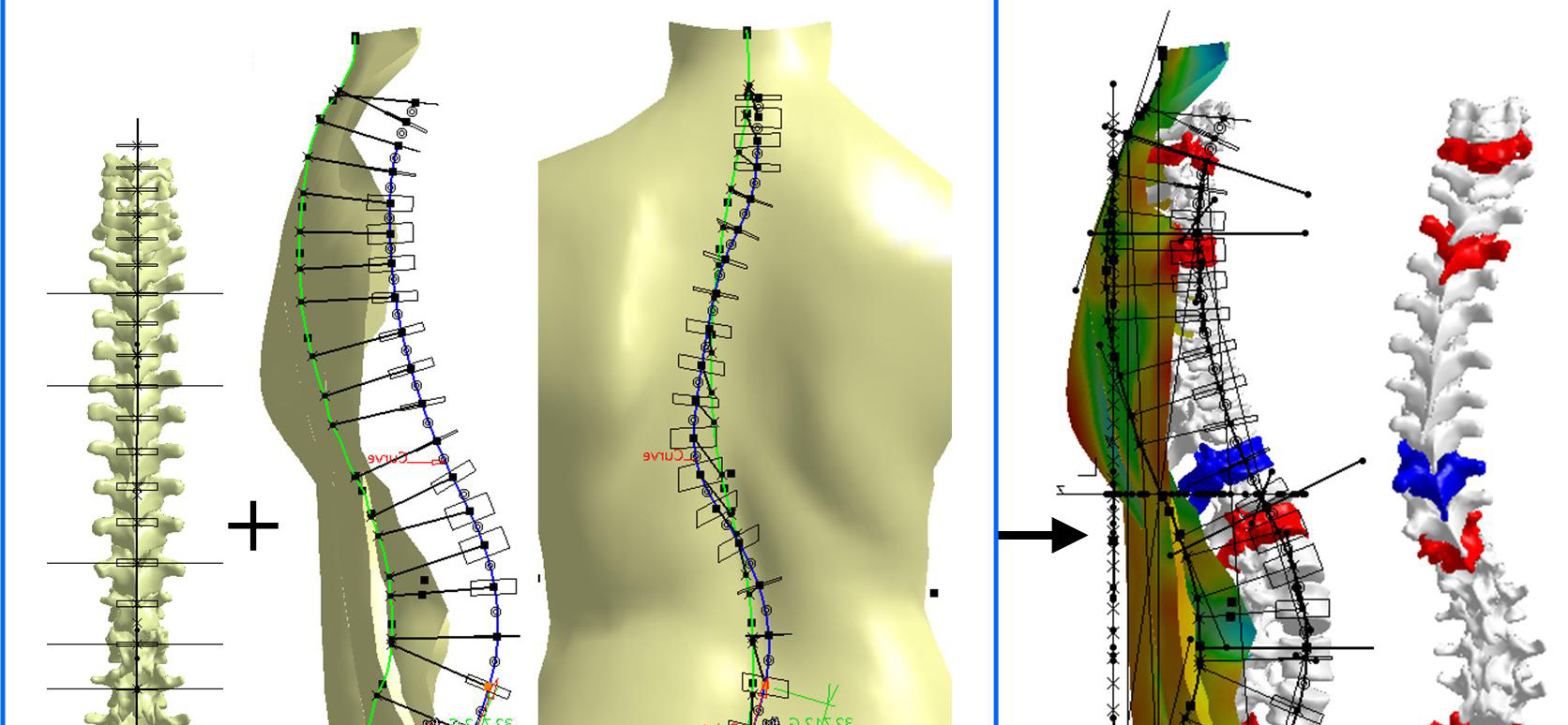 3D Patient-Specific Modeling: Innovative Approach for Scoliosis Diagnosis