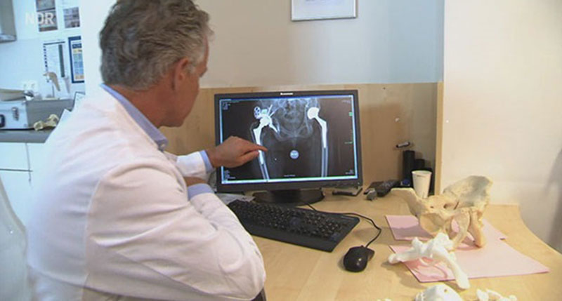 German Patient Walks Again with Patient-Specific 3D-Printed Hip Implant