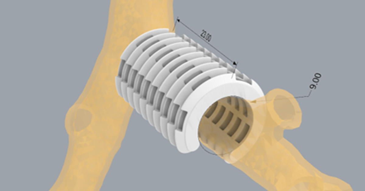 Tracheal-splints-design