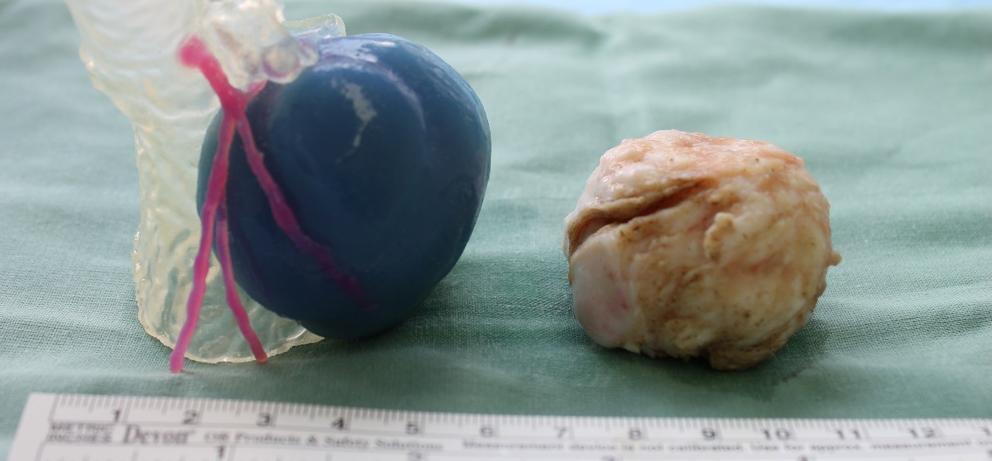 Challenging Heart Tumor Successfully Removed Thanks to European Collaboration