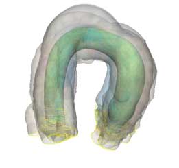 Mimics software view of an aortic arch in SSM being created