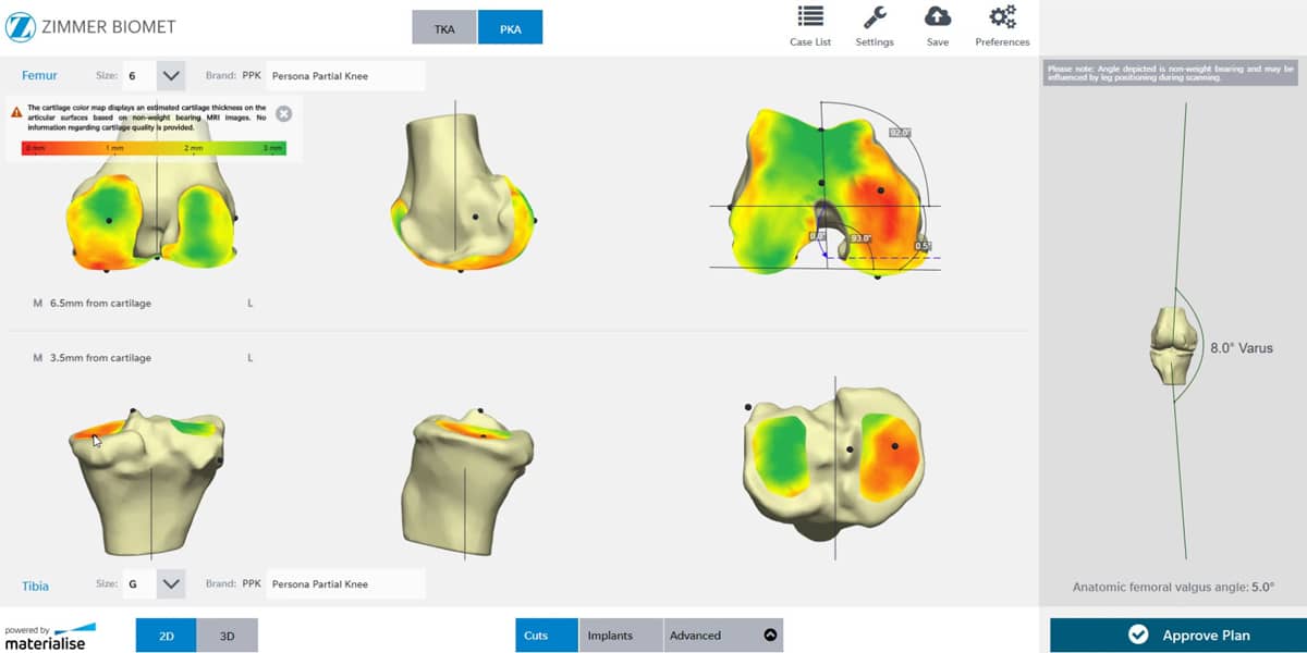 Personalized Guides for Partial Knee Replacement: A Conversation with Zimmer Biomet