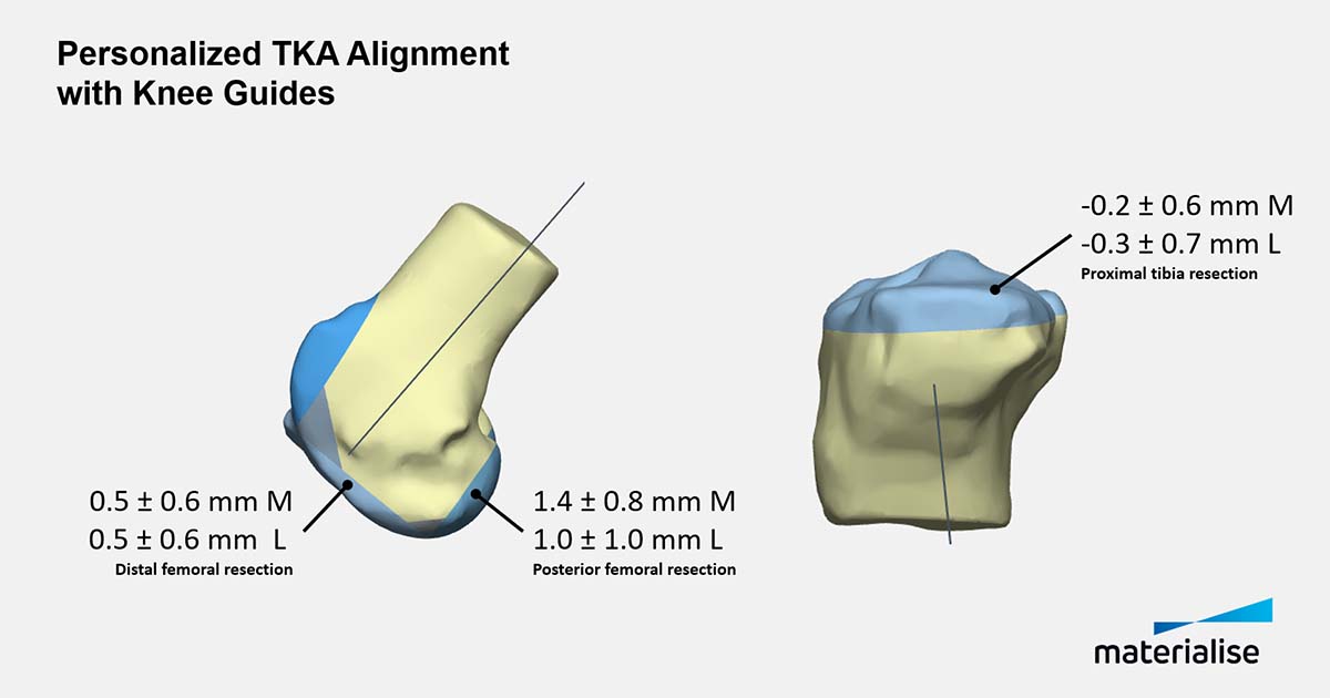 Knee Guides Precisely Execute Personalized TKA Alignment