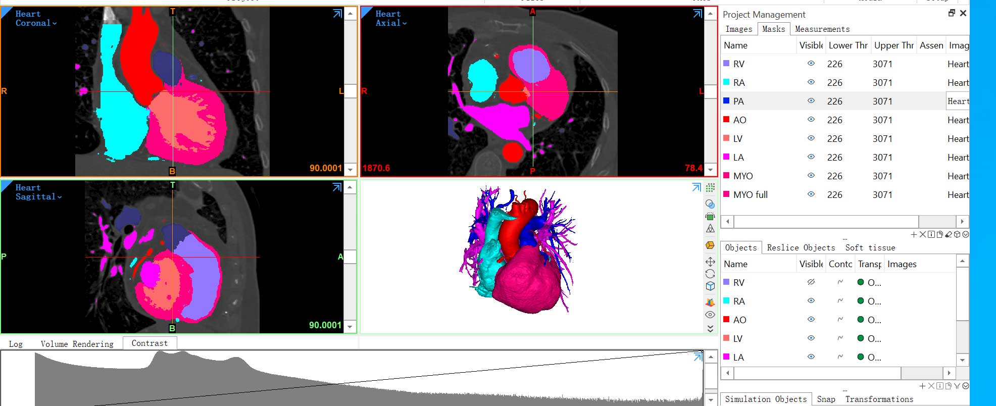View of Mimics software performing an automatic segmentation of a full heart
