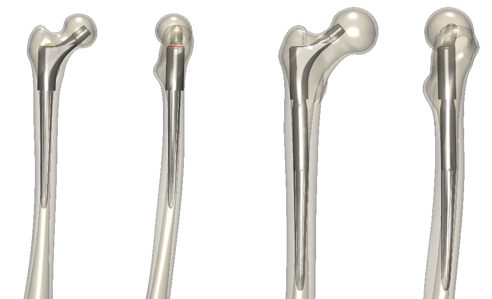 Implantations virtuelles de l’impact d’une hanche de révision DJO chez le patient synthétique du 5e percentile (à gauche) et le patient synthétique du 99,7e percentile (à droite) 
