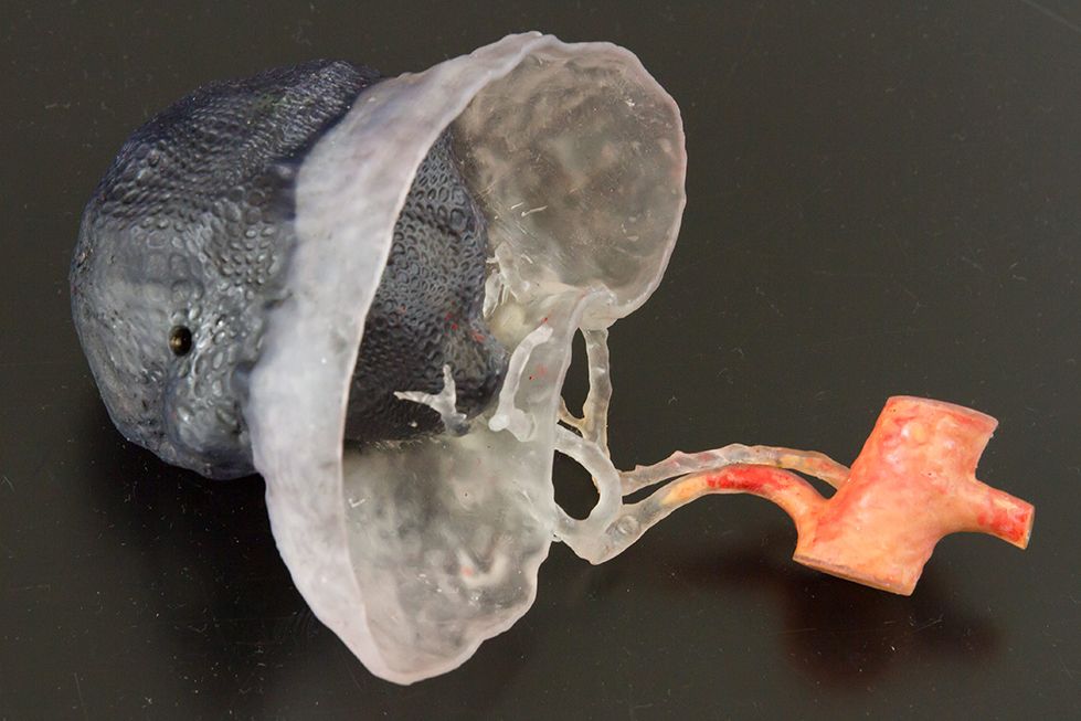 Modèle anatomique multicolore imprimé en 3D d’une tumeur rénale, SLA  