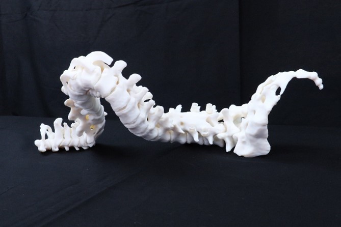 3D-printed model of Zoés spine 