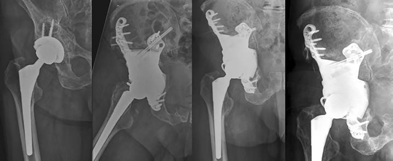 Innovative aMace Technology for Complex Pelvic Tumor Resection and Reconstruction