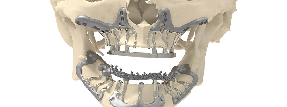 3D-Printed Titanium Jaw Implant