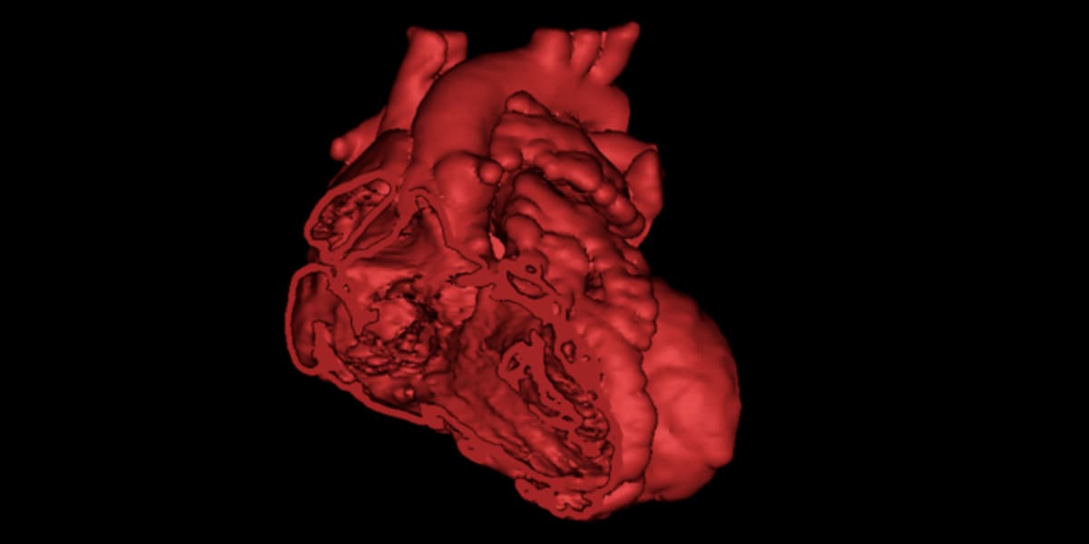 Personalisierte Prognosen in 3D für Patienten mit angeborenen Herzerkrankungen gewinnen Mimics Innovation Award