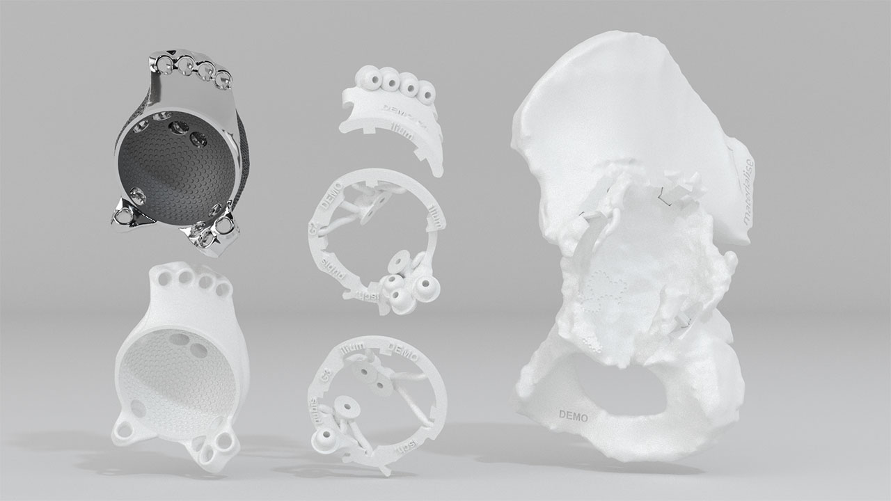 Set with model of the patient-specific hip implant that was used for this patient