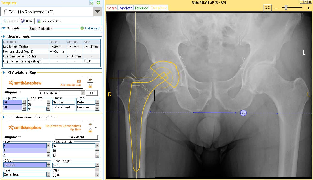 Correcting-the-femoral-offset-2.jpg