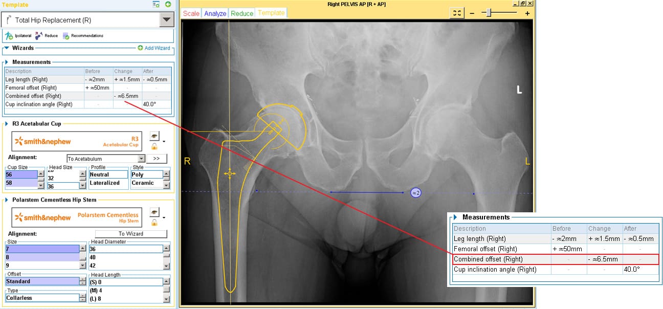 Correcting-the-femoral-offset.jpg