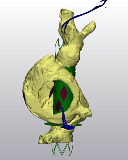 3D representation of the heart in Materialise 3-matic