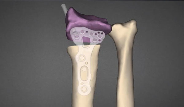 3D Osteotomy Planning with the Clinical Engineer