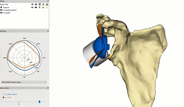 Planning a Glenius Personalized Shoulder Implant with the Clinical Engineer