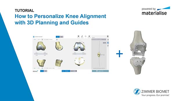 How to personalize knee alignment with 3D planning and guides