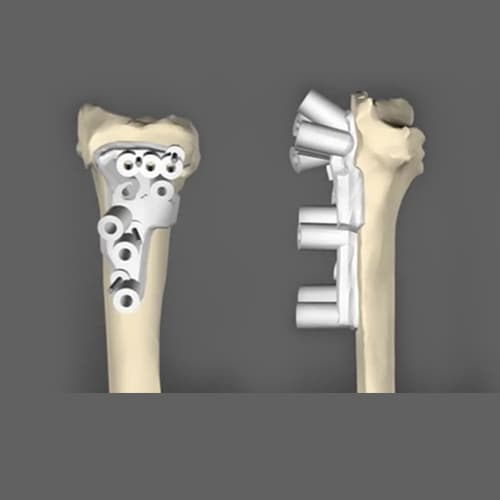 Corrective Osteotomies.jpg