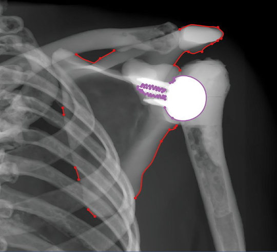 Shoulder Implant on X-Ray image