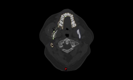 Virtual simulation of the skeletal osteotomies and reconstruction