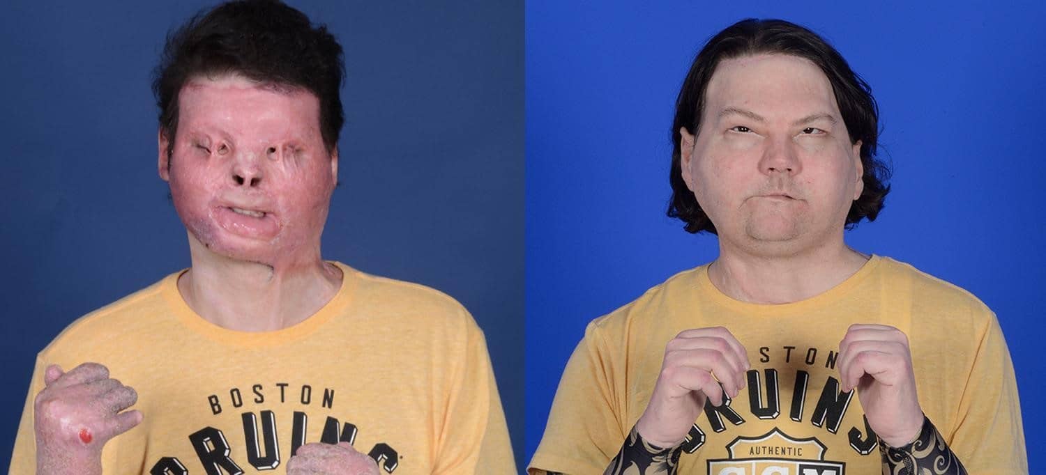 Two pictures of a same man before and after the double hand and face transplant