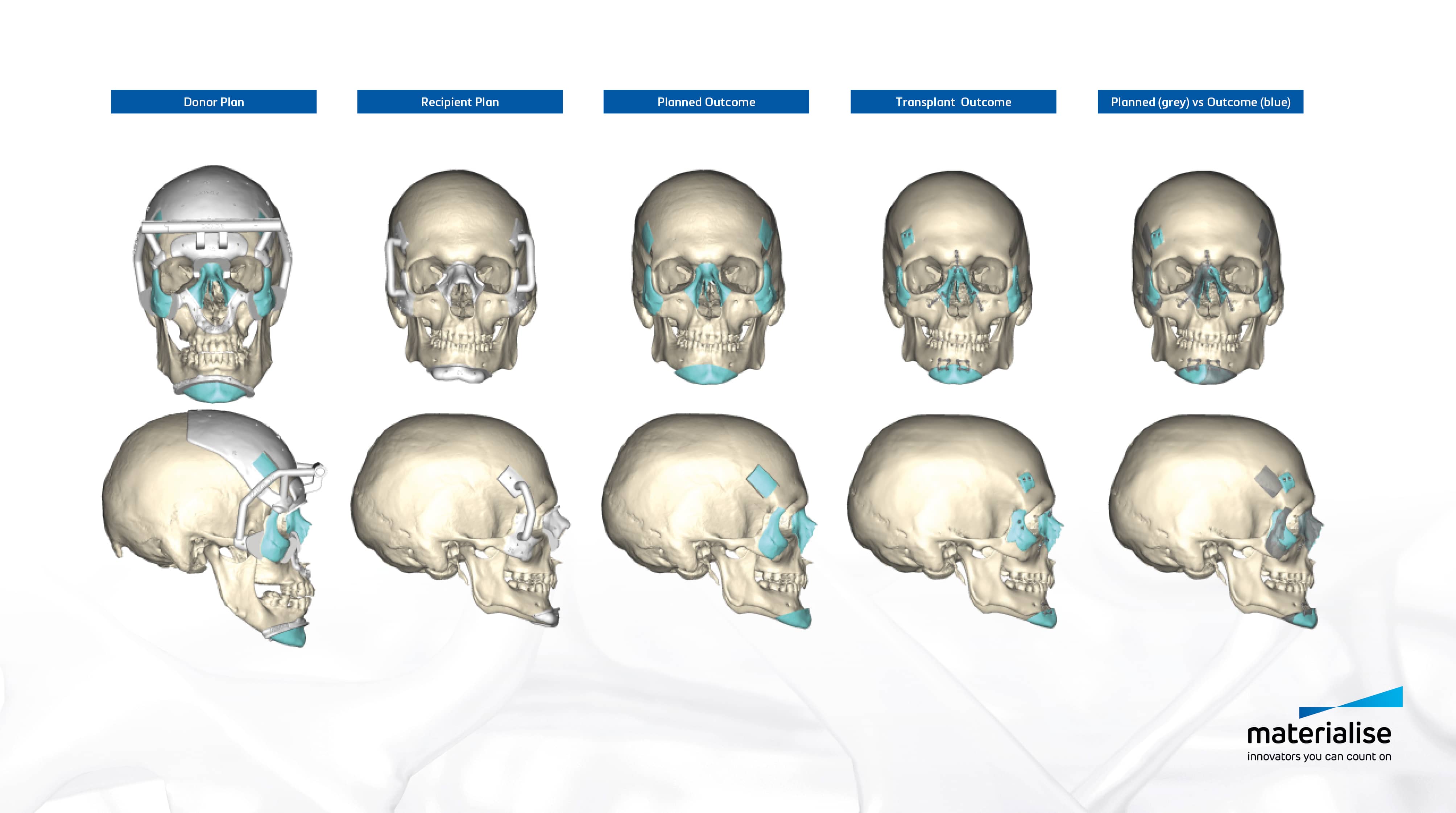 3D scans of a human skull from different perspective with medical implants