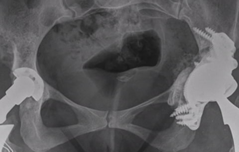 Indications and contraindications to Patient-specific acetabular implants