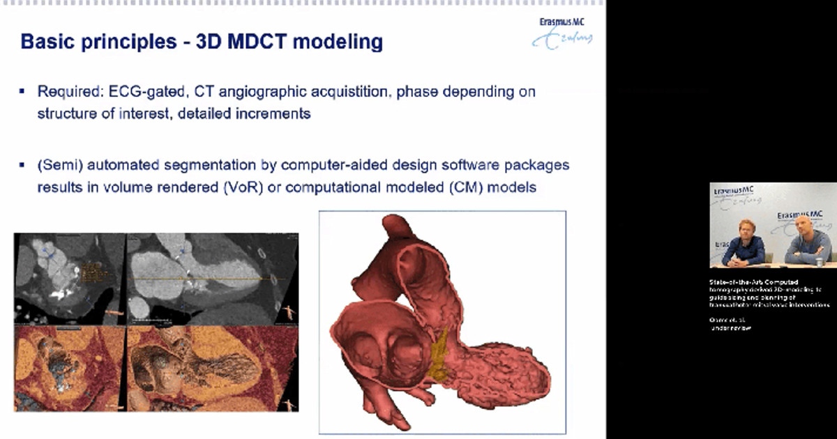 3D Planning for Structural Heart Interventions 