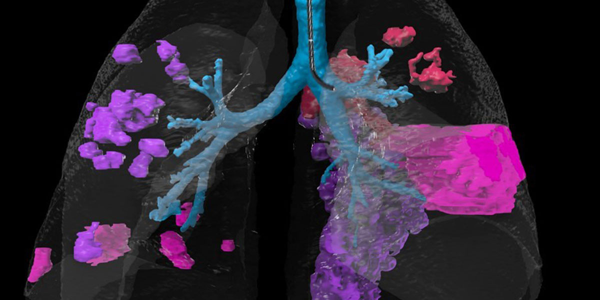 Making Pulmonary Interventions Truly Personalized