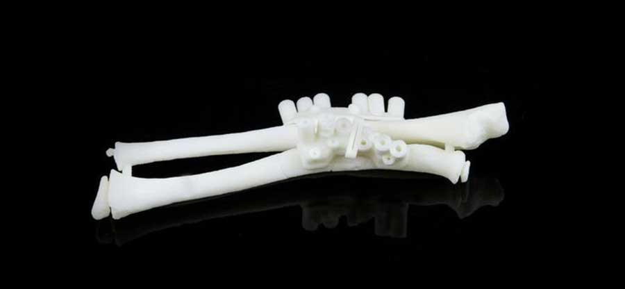3D Planning for forearm Malunions correction: When and How to Use Personalized Guides