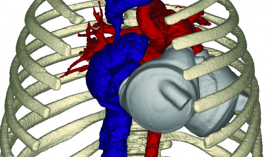 Total Artificial Heart Implantation Planning
