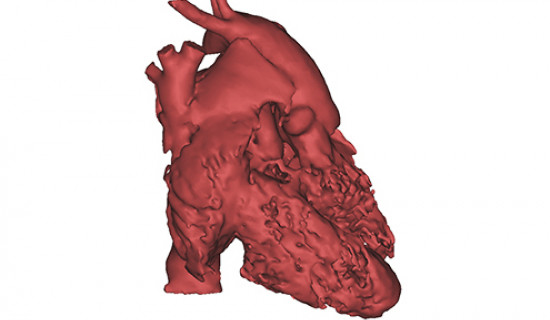 3D-Printed Congenital Heart Defect Models for Pre-Surgical Planning