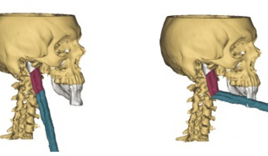 Surgical Planning Software Plays a Key Role in Mandible Reconstruction