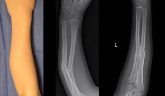 Patient-Specific Guides and Plates for a Double Forearm Malunion Case