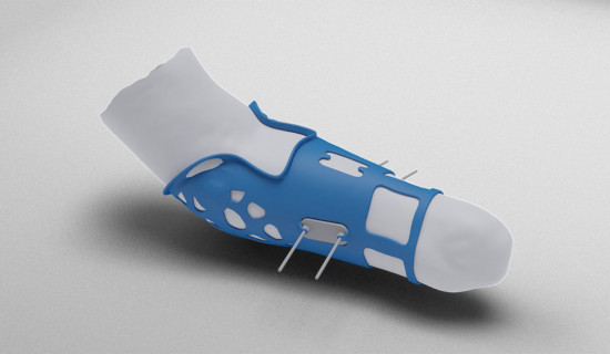 HeyGears Creates Personalized Prosthetic Designs in Seconds with Materialise API