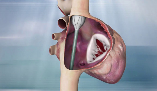 Tricuspid Valve Replacement: 3D Helps Device Reach Market