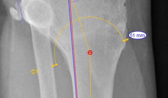 Planning a total knee replacement & tibial osteotomy to replace & realign the knee joint