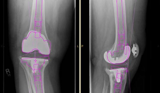 Time saved in the OR by identifying the right components for knee revision in advance