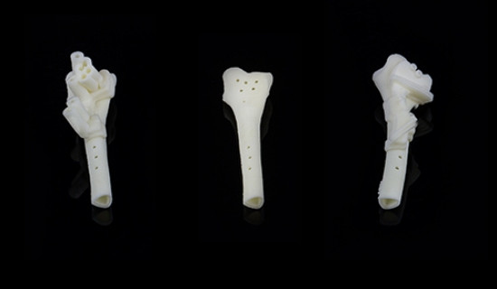 Corrective osteotomy of the distal radius on the right