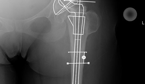 Templating a Complex Modular stem for a THR on a Dysplastic Hip & Planning a Subatractive Osteotomy