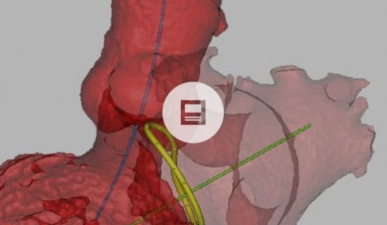 Materialise Mimics® CT Heart tool for heart chamber segmentation:  quantitative validation