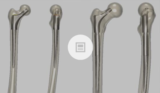 Virtual Patients: A Reality in Orthopedic Implant R&D