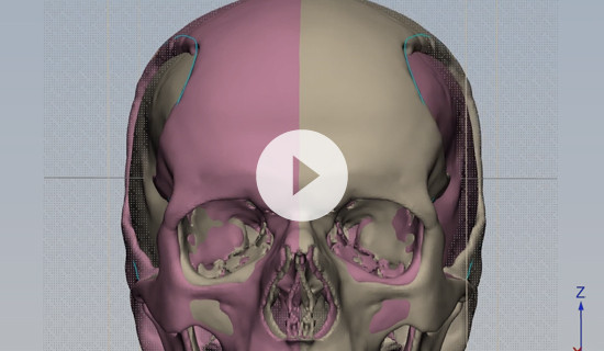 How to design a patient-specific cranial plate