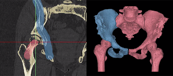 Saving Time in Your Medical Image Segmentation Process with Mimics 19