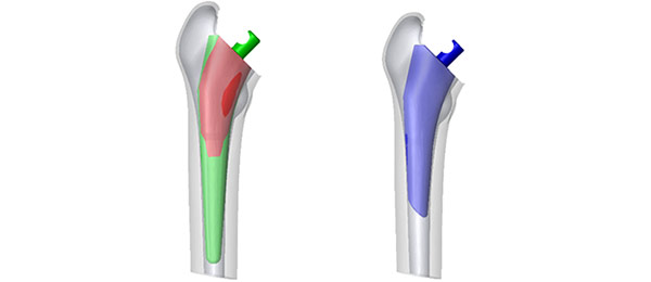 Links: Originaldesign in einem durchschnittlichen Knochenmodell mit sichtbaren Überschneidungen zwischen Implantat und Kortikalis. Rechts: Neues Implantatdesign mit Populations-Analyse.